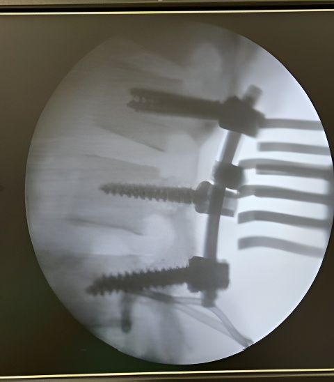Cirurgia de columna