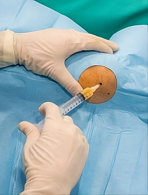 Infiltracions corticoanestèsiques