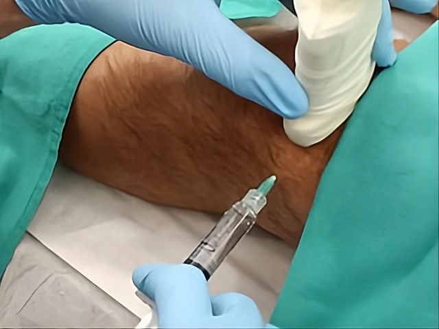 Infiltracions d’àcid hialurònic